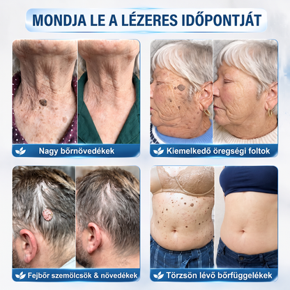 💙𝐇𝐈𝐒𝐊𝐈𝐍®👩‍⚕️ Címke és Folt Eltávolító 7 Nap – Fájdalommentes, Hegmentes Fejlett Bőrhibák Eltávolító Golyós Toll