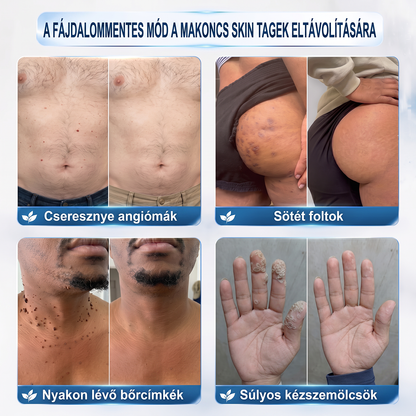 💙𝐇𝐈𝐒𝐊𝐈𝐍®👩‍⚕️ Címke és Folt Eltávolító 7 Nap – Fájdalommentes, Hegmentes Fejlett Bőrhibák Eltávolító Golyós Toll