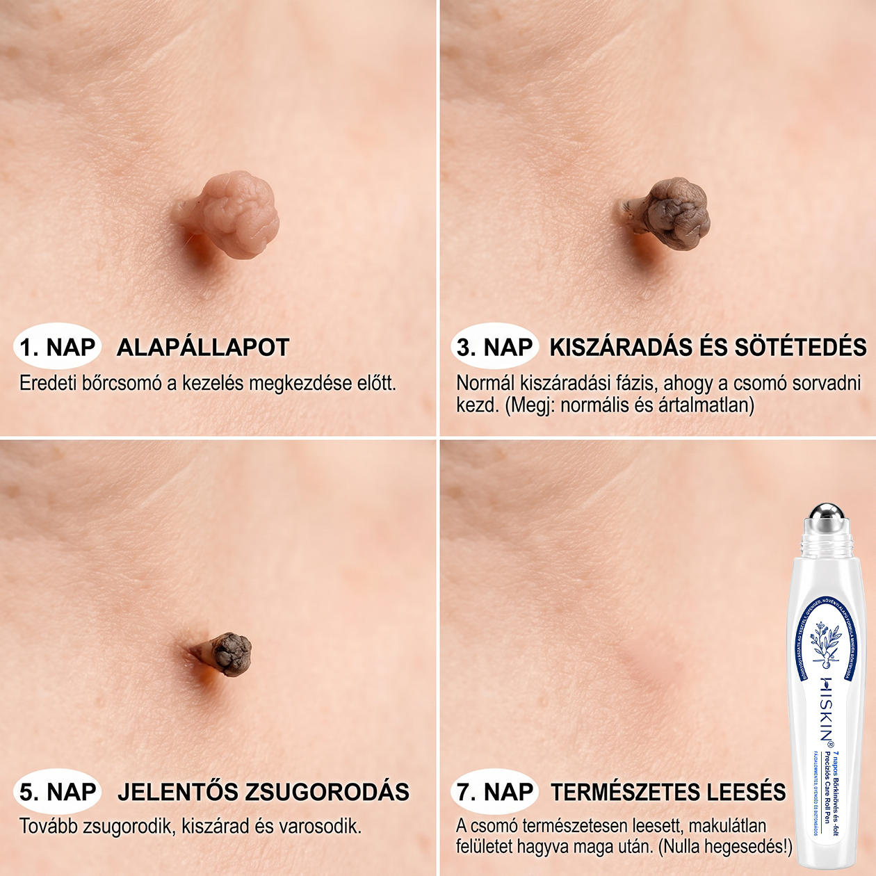 💙𝐇𝐈𝐒𝐊𝐈𝐍®👩‍⚕️ Címke és Folt Eltávolító 7 Nap – Fájdalommentes, Hegmentes Fejlett Bőrhibák Eltávolító Golyós Toll