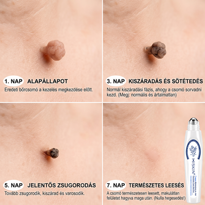 💙𝐇𝐈𝐒𝐊𝐈𝐍®👩‍⚕️ Címke és Folt Eltávolító 7 Nap – Fájdalommentes, Hegmentes Fejlett Bőrhibák Eltávolító Golyós Toll